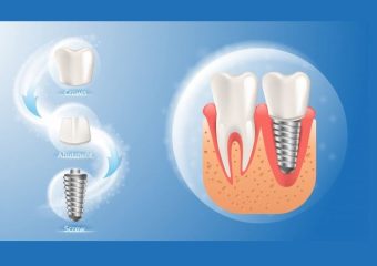 بهترین ایمپلنت اصفهان | بهترین دندانپزشک زیبایی اصفهان | اهمیت بهداشت دهان و دندان در افزایش طول عمر ایمپلنت‌های دندانی | بهترین ایمپلنت اصفهان | دکتر ندا مکانیک