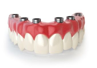 بازسازی کامل دهان با ایمپلنت‌های تمام قوس | بهترین ایمپلنت اصفهان | بهترین دندانپزشک زیبایی اصفهان | دکتر ندا مکانیک