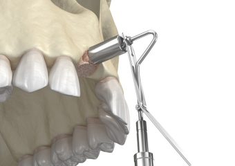 بهترین ایمپلنت اصفهان | بهترین دندانپزشک زیبایی اصفهان | تکنیک‌های جدید پیوند استخوان پیش از کاشت ایمپلنت‌ دندان | بهترین ایمپلنت اصفهان | دکتر ندا مکانیک