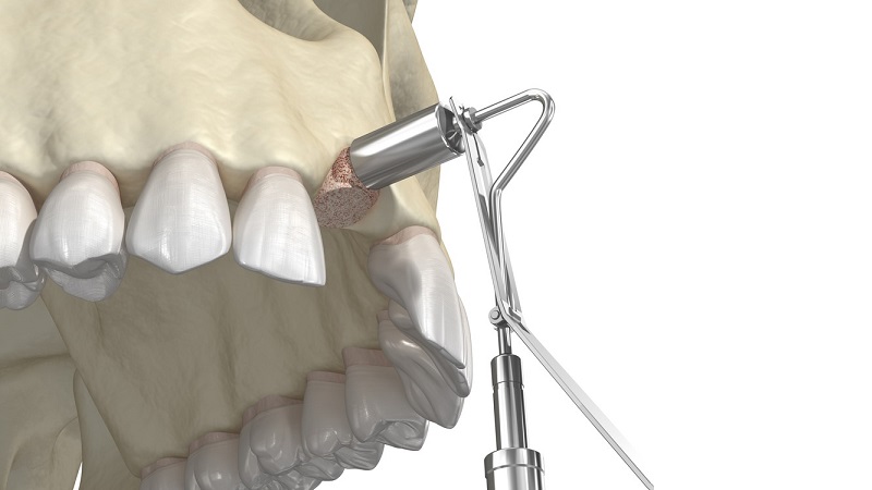 تکنیک‌های جدید پیوند استخوان پیش از کاشت ایمپلنت‌ دندان | بهترین ایمپلنت اصفهان | دکتر ندا مکانیک