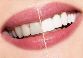 بهترین ایمپلنت اصفهان | بهترین دندانپزشک زیبایی اصفهان | تکنیک‌های نوین بلیچینگ در بهبود زیبایی دندان‌ها در بزرگسالان | بهترین دندانپزشک اصفهان | دکتر ندا مکانیک