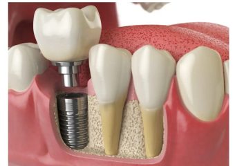 حفظ بافت‌های نرم و سخت دهان در کاشت ایمپلنت | بهترین ایمپلنت اصفهان | بهترین دندانپزشک زیبایی اصفهان | دکتر ندا مکانیک
