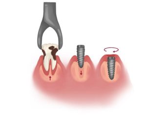 درمان سریع برای جایگزینی دندان‌های از دست رفته با ایمپلنت فوری | بهترین ایمپلنت اصفهان | بهترین دندانپزشک زیبایی اصفهان | دکتر ندا مکانیک