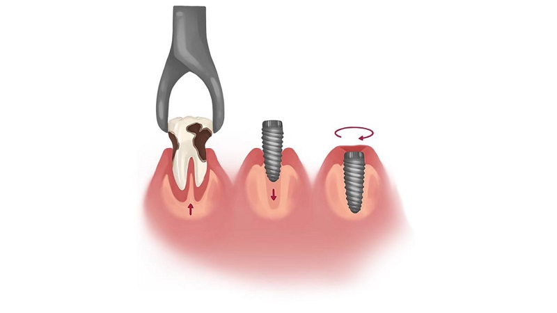 درمان سریع برای جایگزینی دندان‌های از دست رفته با ایمپلنت فوری | بهترین ایمپلنت اصفهان | دکتر ندا مکانیک