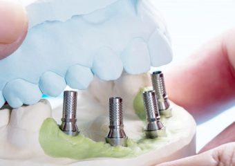 بهترین ایمپلنت اصفهان | بهترین دندانپزشک زیبایی اصفهان | راهکارهای بهینه برای افزایش طول عمر ایمپلنت‌های دندانی | بهترین دندانپزشک اصفهان | دکتر ندا مکانیک