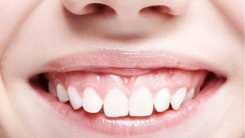 روش‌های اصلاح لبخند لثه‌ای با تکنولوژی‌های پیشرفته | بهترین دندانپزشک زیبایی اصفهان | دکتر ندا مکانیک