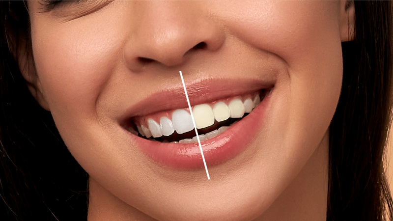 بهترین ایمپلنت اصفهان | بهترین دندانپزشک زیبایی اصفهان | روش‌های مختلف سفید کردن دندان و تاثیر آنها بر مینای دندان | بهترین دندانپزشک اصفهان | دکتر ندا مکانیک