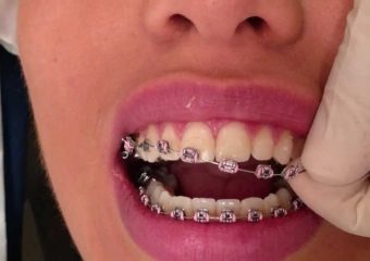 بهترین ایمپلنت اصفهان | بهترین دندانپزشک زیبایی اصفهان | علل و مراحل پوسیده شدن دندان در ارتودنسی | بهترین دندانپزشک اصفهان | دکتر ندا مکانیک