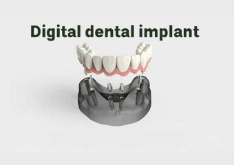 فناوری دیجیتال و مواد زیست‌سازگار در بازسازی دندان با ایمپلنت |بهترین ایمپلنت اصفهان | بهترین دندانپزشک زیبایی اصفهان | دکتر ندا مکانیک