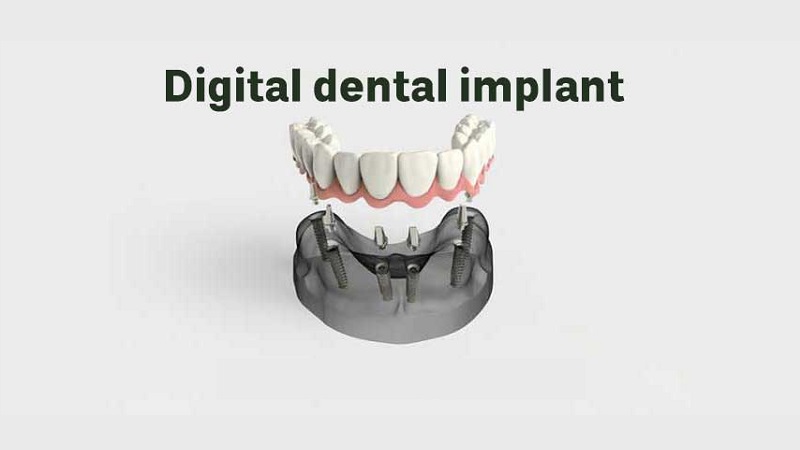 فناوری دیجیتال و مواد زیست‌سازگار در بازسازی دندان با ایمپلنت | بهترین ایمپلنت اصفهان | دکتر ندا مکانیک