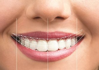 بهترین ایمپلنت اصفهان | فناوری‌های جدید در طراحی و اجرای لبخند دیجیتال | بهترین دندانپزشک زیبایی اصفهان | دکتر ندا مکانیک