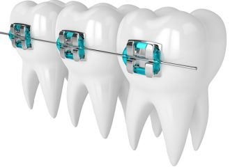 بهترین ایمپلنت اصفهان | بهترین دندانپزشک زیبایی اصفهان | مراحل انجام ارتودنسی یک دندان | بهترین دندانپزشک کودکان اصفهان | دکتر ندا مکانیک
