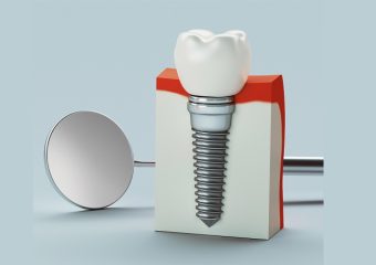 بهترین ایمپلنت اصفهان | بهترین دندانپزشک زیبایی اصفهان | Dental care, dental implant, 3d rendering | بهترین دندانپزشک | اصفهان | دکتر ندا مکانیک