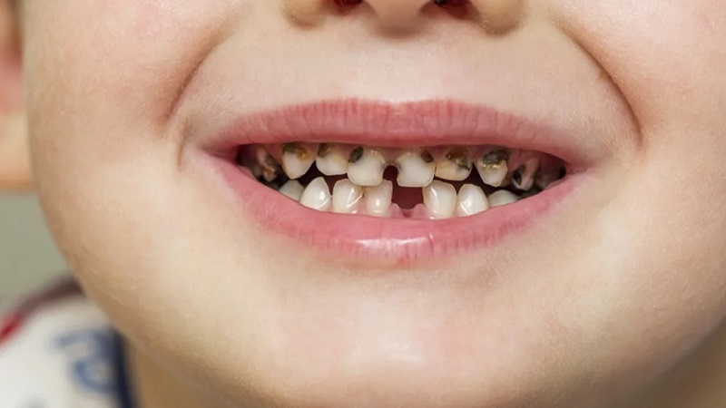 بهترین ایمپلنت اصفهان | بهترین دندانپزشک زیبایی اصفهان | | بهترین دندانپزشک اصفهان | دکتر ندا مکانیک | پیشگیری از پوسیدگی دندان کودکان با کمک پروبیوتیک‌ها و ژل‌های فلورایدی