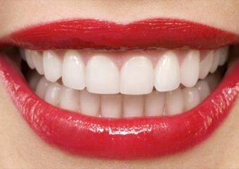 بهترین ایمپلنت اصفهان | بهترین دندانپزشک زیبایی اصفهان | کارایی روش‌های نوین سفید کردن دندان در بزرگسالان | بهترین دندانپزشک زیبایی اصفهان | دکتر ندا مکانیک