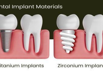 ایمپلنت‌های زیبایی با روکش‌های زیرکونیایی | بهترین ایمپلنت اصفهان | بهترین دندانپزشک زیبایی اصفهان | دکتر ندا مکانیک