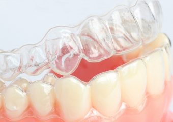 بهترین ایمپلنت اصفهان | روشهای تمیز کردن نگهدارنده شفاف و متحرک | بهترین دندانپزشک زیبایی اصفهان | دکتر ندا مکانیک