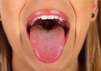 بهترین ایمپلنت اصفهان | بهترین دندانپزشک زیبایی اصفهان | عوامل زرد شدن زبان | بهترین دندانپزشک اصفهان | دکتر ندا مکانیک