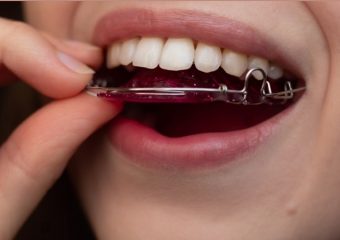 بهترین ایمپلنت اصفهان | بهترین دندانپزشک زیبایی اصفهان | دکتر ندا مکانیک | بهترین دندانپزشک اصفهان | مراحل قرار دادن نگهدارنده ارتودنسی هاولی