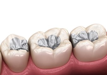 مزایا و معایب ترمیم دندان با آمالگام | بهترین ایمپلنت اصفهان | بهترین دندانپزشک زیبایی اصفهان | دکتر ندا مکانیک