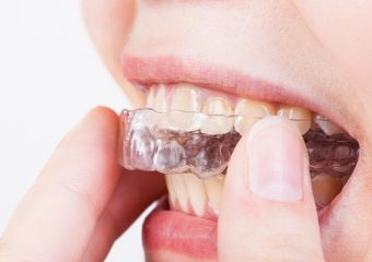 افراد نیازمند به استفاده از نایت گارد |بهترین ایمپلنت اصفهان | بهترین دندانپزشک زیبایی اصفهان | دکتر ندا مکانیک