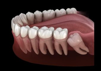 بهترین ایمپلنت اصفهان | بهترین دندانپزشک زیبایی اصفهان | انواع مختلف دندان عقل | بهترین دندانپزشک اصفهان | دکتر ندا مکانیک