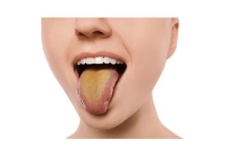 بهترین ایمپلنت اصفهان | بهترین دندانپزشک زیبایی اصفهان | راه های درمانی برای زردی زبان | بهترین دندانپزشک اصفهان | دکتر ندا مکانیک