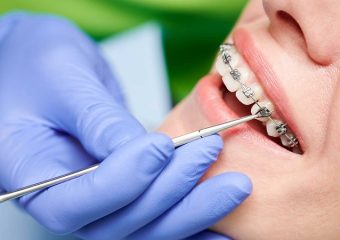 بهترین ایمپلنت اصفهان | بهترین دندانپزشک زیبایی اصفهان | دکتر ندا مکانیک | بهترین دندانپزشک اصفهان | دکتر ندا مکانیک | راهنمای جامع اصطلاحات ارتودنسی دندان