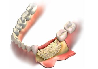 بهترین ایمپلنت اصفهان | بهترین دندانپزشک زیبایی اصفهان | روش های مختلف پیوند استخوان فک | بهترین دندانپزشک اصفهان | دکتر ندا مکانیک