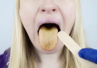 بهترین ایمپلنت اصفهان | بهترین دندانپزشک زیبایی اصفهان | علائم رایج همراه با زردی زبان | بهترین دندانپزشک اصفهان | دکتر ندا مکانیک