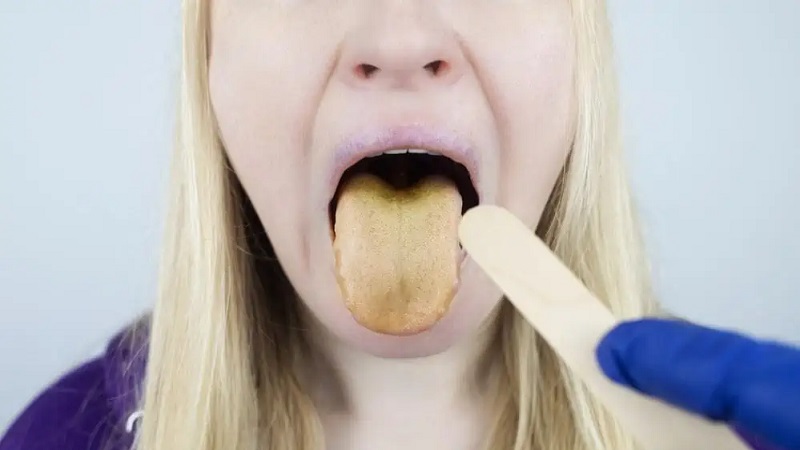 بهترین ایمپلنت اصفهان | بهترین دندانپزشک زیبایی اصفهان | علائم رایج همراه با زردی زبان | بهترین دندانپزشک اصفهان | دکتر ندا مکانیک