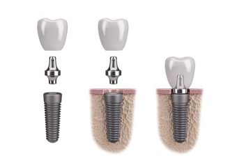 بهترین ایمپلنت اصفهان | بهترین دندانپزشک اصفهان | عوامل موثر در تعیین بهترین زمان کاشت ایمپلنت | بهترین دندانپزشک اصفهان | دکتر ندا مکانیک