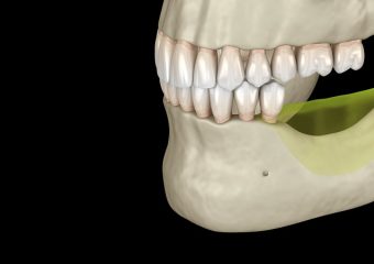 مراحل انجام پیوند استخوان فک | بهترین ایمپلنت اصفهان | دکتر ندا مکانیک