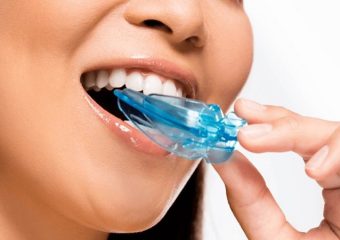 مزیت های استفاده از نایت گارد | بهترین ایمپلنت اصفهان | بهترین دندانپزشک زیبایی اصفهان | دکتر ندا مکانیک