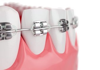 بهترین ایمپلنت اصفهان | بهترین دندانپزشک زیبایی اصفهان | بهترین دندانپزشک اصفهان | دکتر ندا مکانیک | Close up Beauty Health Teeth with Brace. Selective focus. 3D Render.