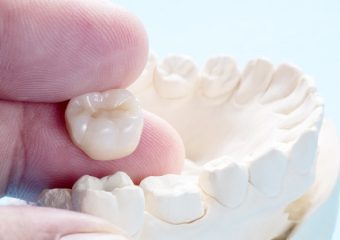 بهترین ایمپلنت اصفهان | بهترین دندانپزشک زیبایی اصفهان | بهترین دندانپزشک اصفهان | دکتر ندا مکانیک | مقایسه مزایا و معایب ایمپلنت و روکش دندان