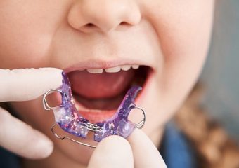 بهترین ایمپلنت اصفهان | بهترین دندانپزشک اصفهان | آشنایی با ابزارهای ارتودنسی متحرک | بهترین دندانپزشک اصفهان | دکتر ندا مکانیک