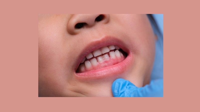 بهترین ایمپلنت اصفهان | بهترین دندانپزشک اصفهان | ارتباط بین فاصله دندانی و سلامت لثه در کودکان | بهترین دندانپزشک اصفهان | دکتر ندا مکانیک