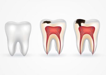 بهترین ایمپلنت اصفهان | بهترین دندانپزشک اصفهان | تشخیص زودهنگام پوسیدگی دندان و راهکارهای درمانی مبتنی بر شواهد | بهترین دندانپزشک اصفهان | دکتر ندا مکانیک