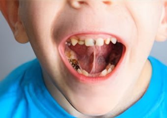 بهترین ایمپلنت اصفهان | بهترین دندانپزشک اصفهان | جرم سیاه دندان در کودکان | بهترین دندانپزشک کودکان اصفهان | دکتر ندا مکانیک