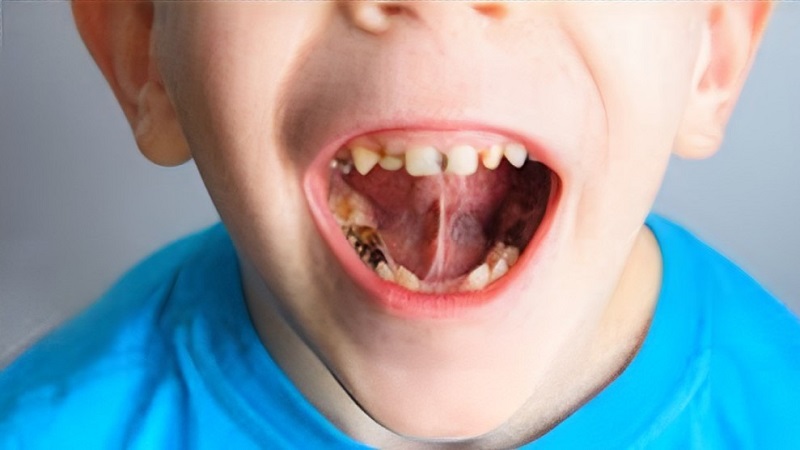 بهترین ایمپلنت اصفهان | بهترین دندانپزشک اصفهان | جرم سیاه دندان در کودکان | بهترین دندانپزشک کودکان اصفهان | دکتر ندا مکانیک