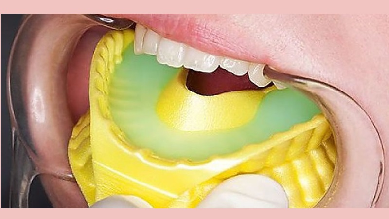 بهترین ایمپلنت اصفهان | بهترین دندانپزشک زیبایی اصفهان | درمان‌های پیشگیرانه مختلف برای دندان | بهترین دندانپزشک کودکان اصفهان | دکتر ندا مکانیک