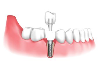 بهترین ایمپلنت اصفهان | بهترین دندانپزشک اصفهان | روشهای نوین در رفع عفونت و التهاب اطراف ایمپلنتهای دندانی | بهترین دندانپزشک اصفهان | دکتر ندا مکانیک