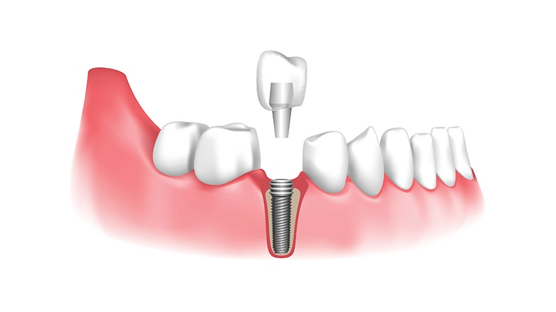 بهترین ایمپلنت اصفهان | بهترین دندانپزشک اصفهان | روشهای نوین در رفع عفونت و التهاب اطراف ایمپلنتهای دندانی | بهترین دندانپزشک اصفهان | دکتر ندا مکانیک