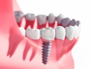 بهترین ایمپلنت اصفهان | بهترین دندانپزشک اصفهان | عوامل کلیدی افزایش طول عمر ایمپلنتهای دندانی | بهترین دندانپزشک اصفهان | دکتر ندا مکانیک