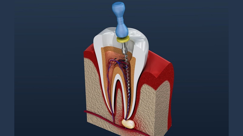 مدیریت و درمان کانال‌های دندان | بهترین دندانپزشک اصفهان | دکتر ندا مکانیک