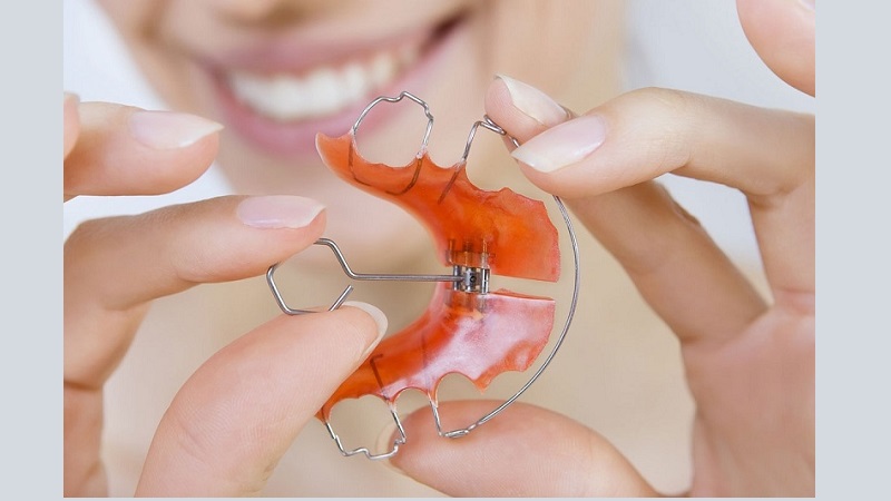 مراحل قرار دادن نگهدارنده اسیکس ارتودنسی | بهترین ایمپلنت اصفهان | دکتر ندا مکانیک