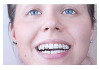 مزایا و معایب انجام ارتودنسی فانکشنال | بهترین ایمپلنت اصفهان | دکتر ندا مکانیک