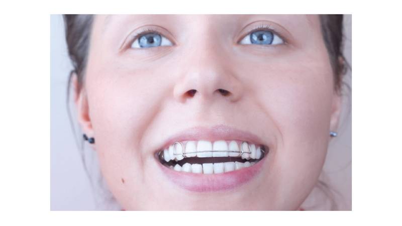 مزایا و معایب انجام ارتودنسی فانکشنال | بهترین ایمپلنت اصفهان | دکتر ندا مکانیک