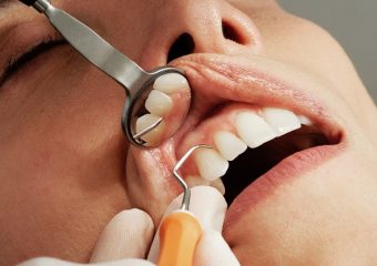 بهترین ایمپلنت اصفهان | بهترین دندانپزشک اصفهان | مزیت ها و معایب انجام کورتاژ لثه | بهترین دندانپزشک اصفهان | دکتر ندا مکانیک